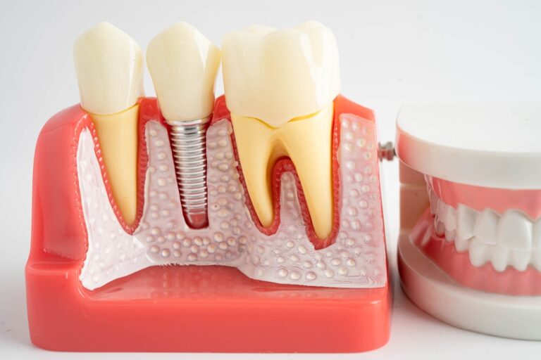 dental implants near me